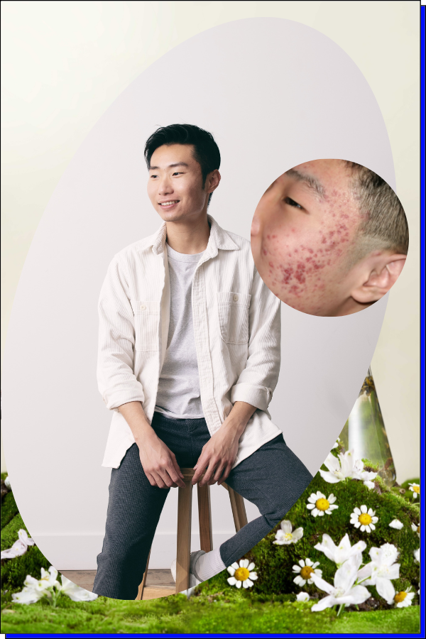 Levi, founder of EQUALRXN, with a close-up of his skin during severe acne